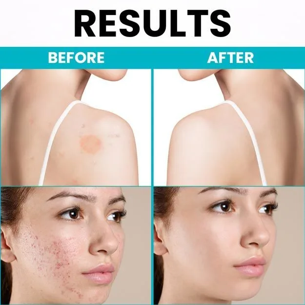 Monobenzone Powder Uses Monobenzone Powder Uses