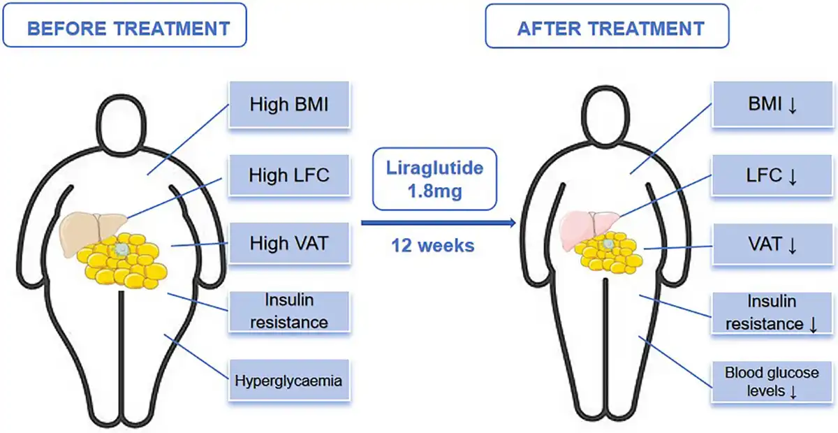 Liraglutide Applications in Metabolic Syndrome Treatment Liraglutide Applications in Metabolic Syndrome Treatment